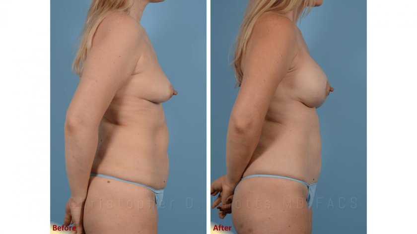 Laser liposuction Smartlipo