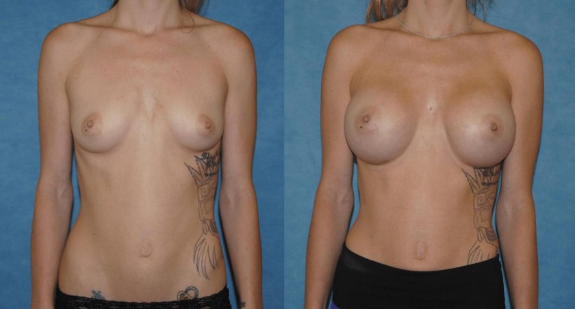 Breast enlargement