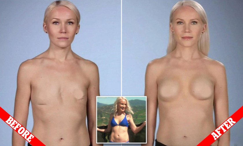 Mastectomy porn actresses