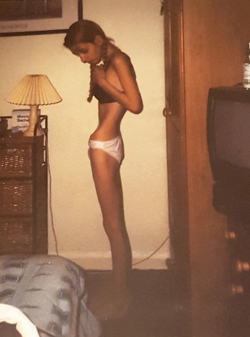 Anastasia Solomatina Anorexia