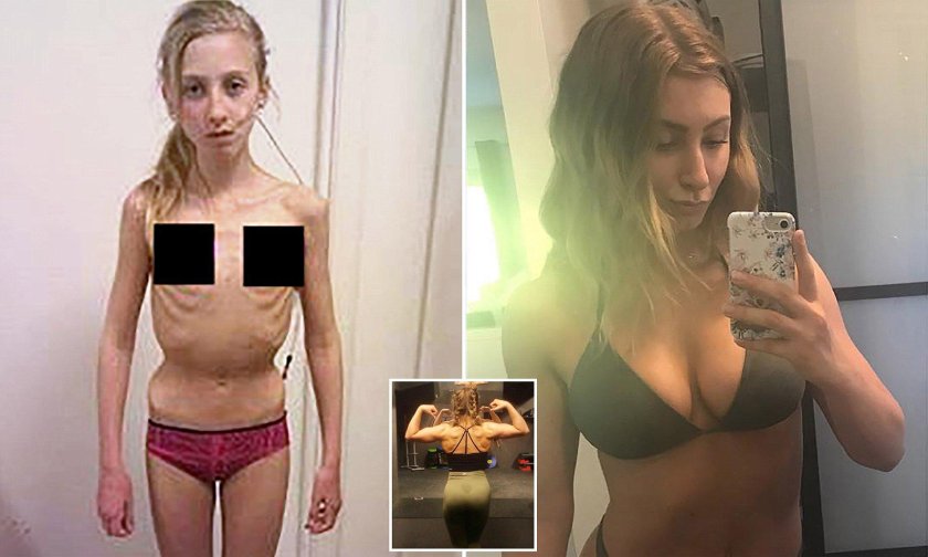 Amanda Christiansen anorexia
