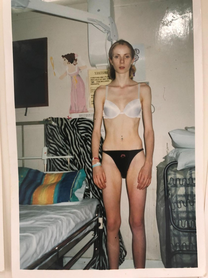 Anorexia nude