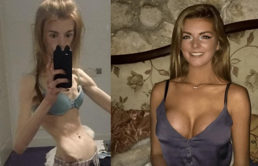 Anorexichka Anna Windley