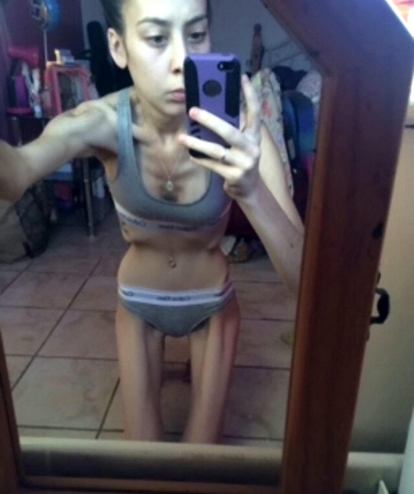 Bridget Malcolm anorexia