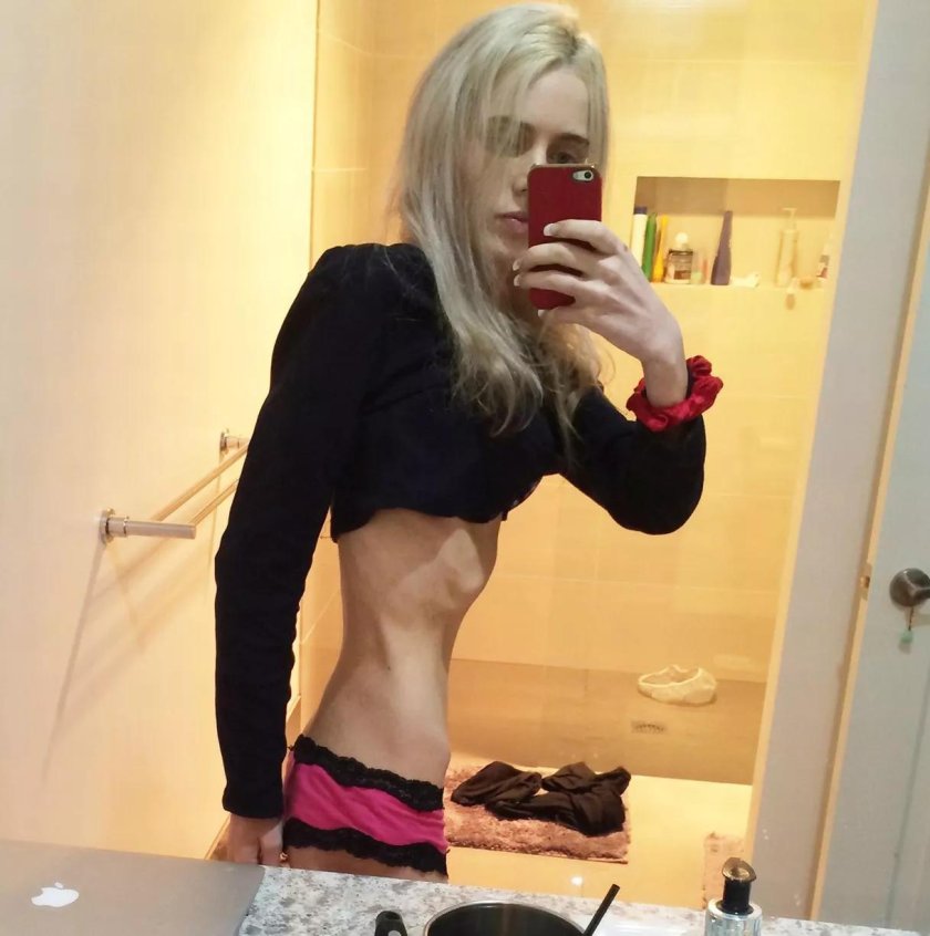 Anorexica with big breasts