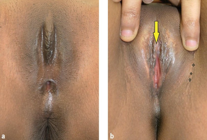 Female circumcision porn