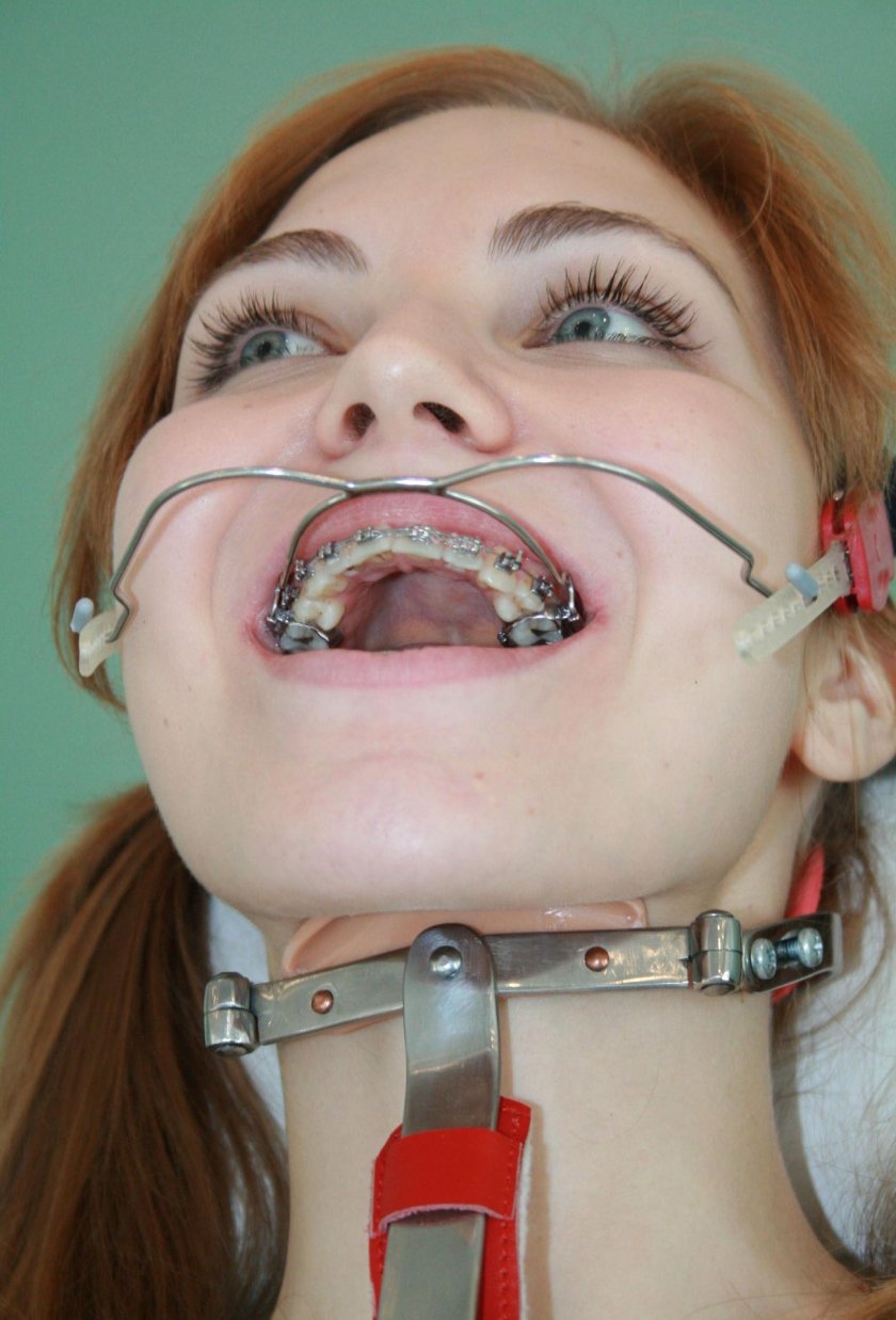 Naked girls braces