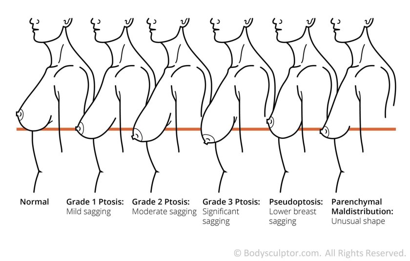Petosis of the thoracic glands degree