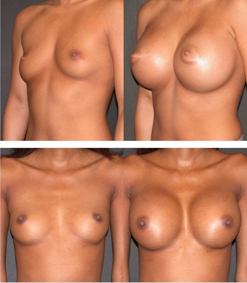 Before and after breast augmentation
