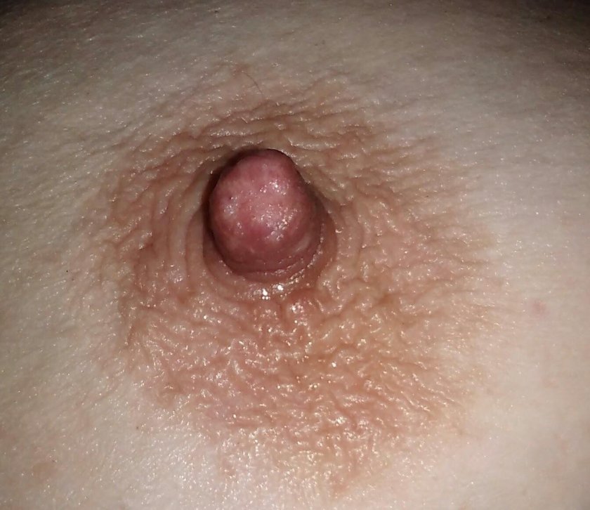 Papilloma on nipples