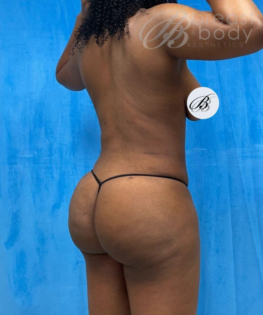 Lipophiling buttocks asymmetry