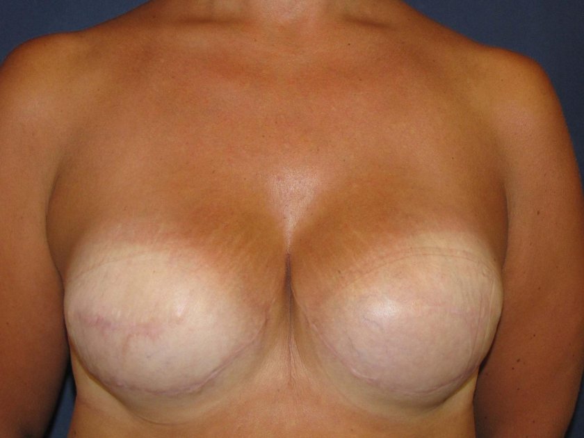 Breast enlargement before and after