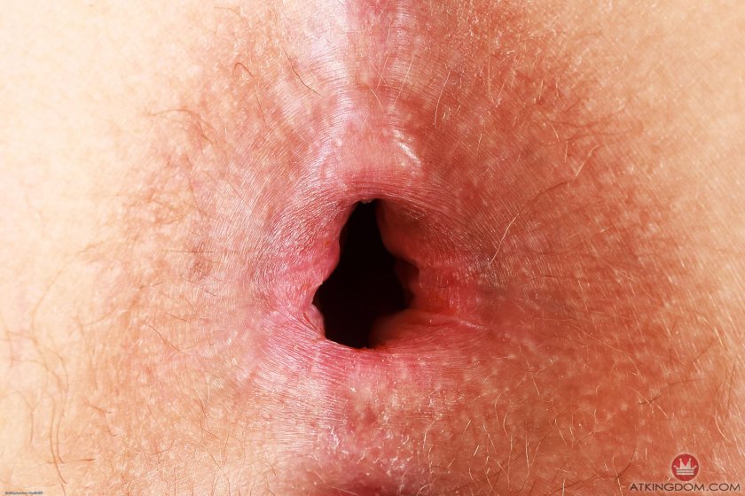 Eosinophilic esophagitis