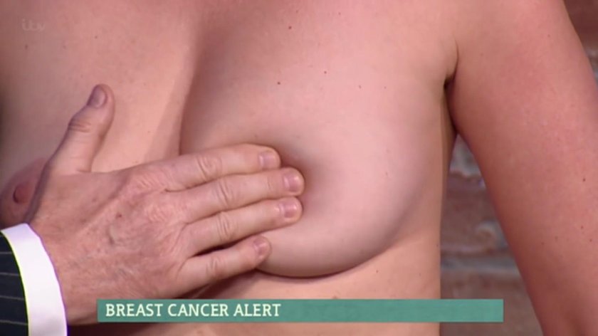 Breast cancer
