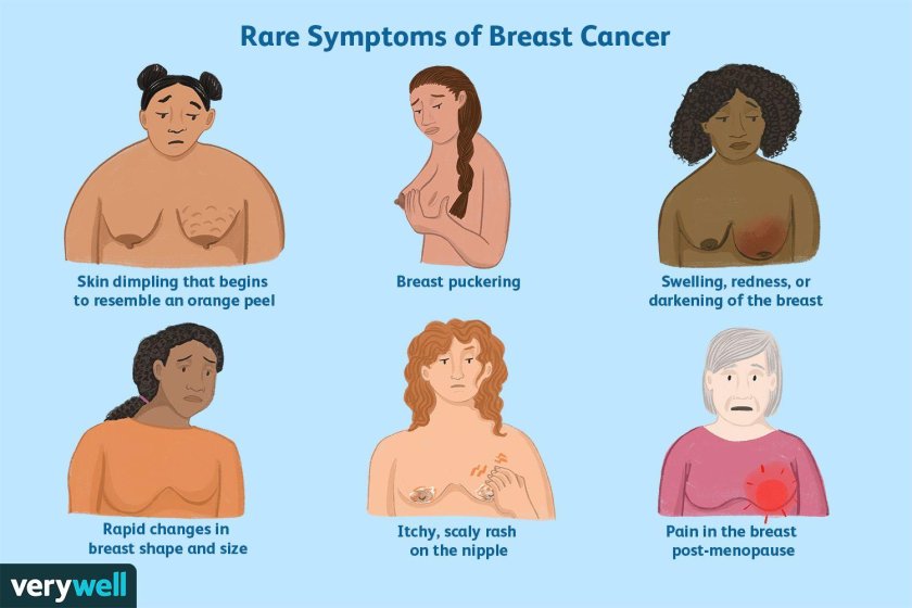 Symptoms of breast cancer
