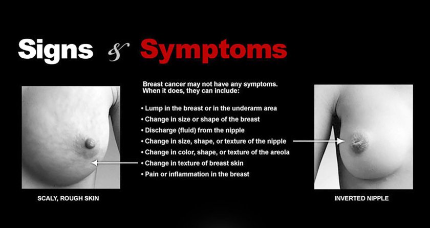 Signs symptoms breast cancer