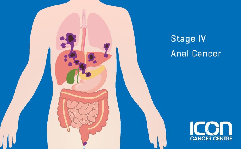 Cancer stages