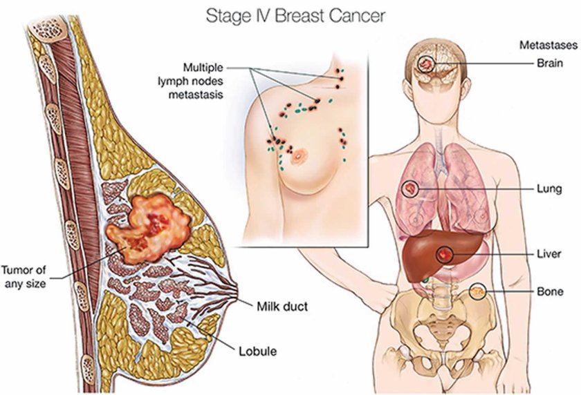 Lymph node metastasis