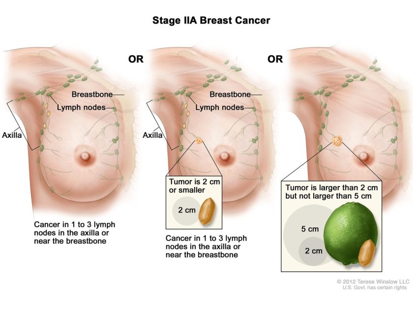 Breast cancer