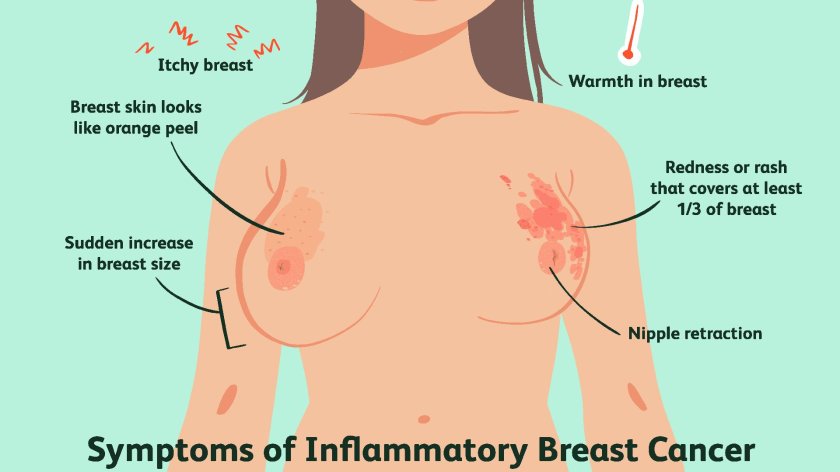 Inflammatory breast cancer