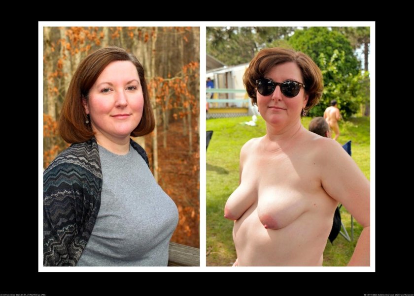 Woman with one breast