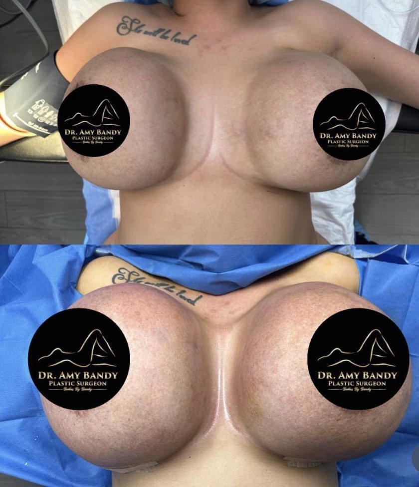 Breast augmentation