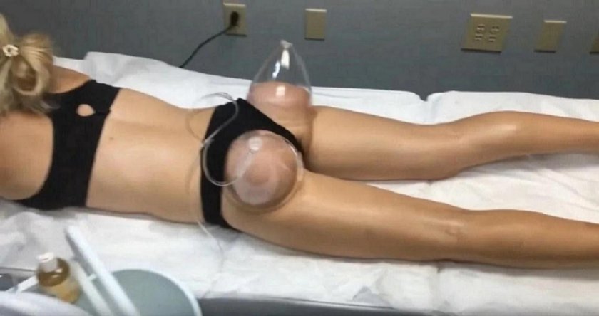 Vacuum breast massage