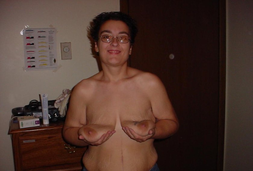 Chest after mastectomy
