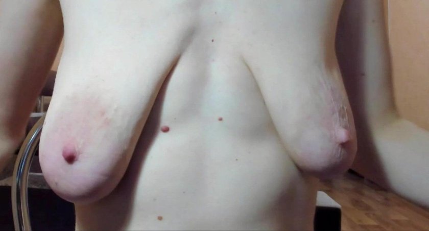 Chest deformation