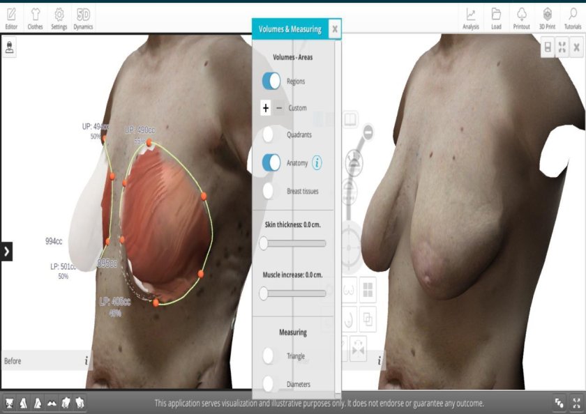 3d breast modeling