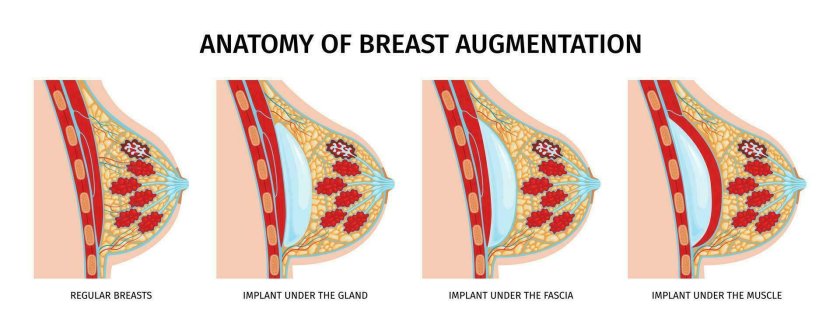Breast augmentation